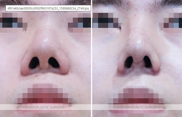 남자복코재수술 비순각 각도 개선 전후 사진 사진 5