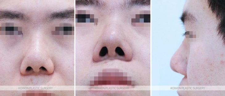 남자복코재수술 비순각 각도 개선 전후 사진