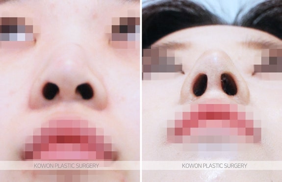 여자긴코성형 코끝내림근제거 전후 사진 사진 4