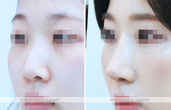 여자긴코성형 코끝내림근제거 전후 사진