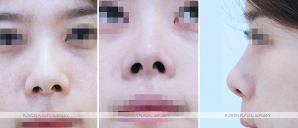 비대칭콧구멍 교정 비중격연장술 전후 사진