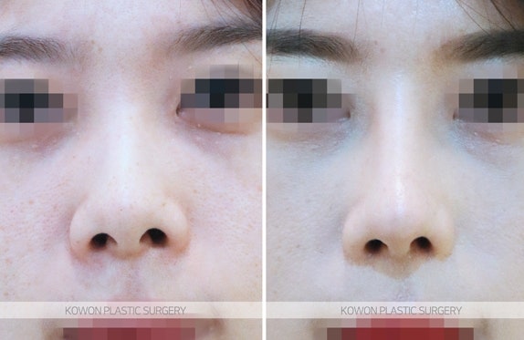 비대칭콧구멍 교정 비중격연장술 전후 사진 사진 5