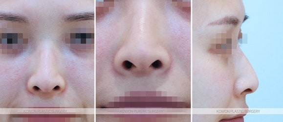 여자매부리코성형 높은 용코/휜코 전후 사진
