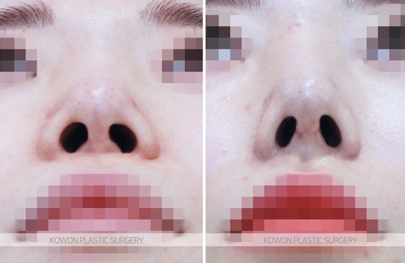 무보형물코성형 기능늑연골 재수술 전후 사진 사진 4