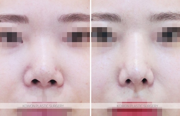 무보형물코성형 기능늑연골 재수술 전후 사진 사진 3