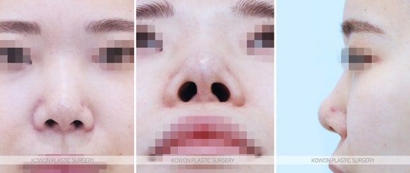 무보형물코성형 기능늑연골 재수술 전후 사진