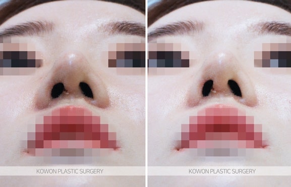 코실제거/미스코실제거 코재수술 전후 사진 사진 6