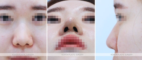 코실제거/미스코실제거 코재수술 전후 사진 사진 2