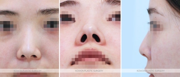 압구정역코수술 비중격만곡증증상 교정 전후 사진