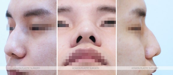 압구정남자코수술 매부리코절골술 전후 사진
