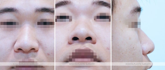 남자콧볼축소술 주먹코/복코 수술 전후 사진
