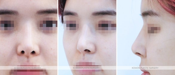 콧구멍짝짝이 직반버선코 재수술 전후 사진