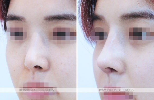 콧구멍짝짝이 직반버선코 재수술 전후 사진