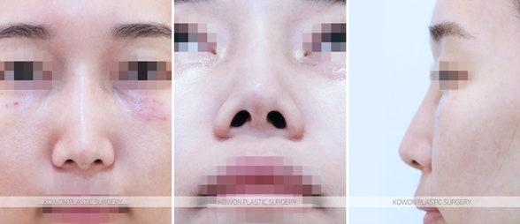 콧대실제거/베이코제거 전후 사진