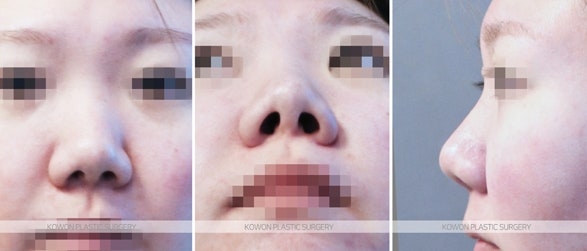 짧은코교정 위한 비중격연장술 후 콧날개줄이기 전후 사진