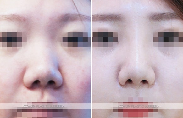짧은코교정 위한 비중격연장술 후 콧날개줄이기 전후 사진 사진 5