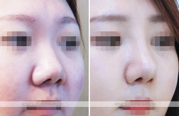 짧은코교정 위한 비중격연장술 후 콧날개줄이기 전후 사진 사진 3