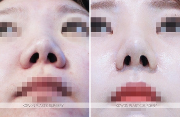 짧은코교정 위한 비중격연장술 후 콧날개줄이기 전후 사진 사진 4