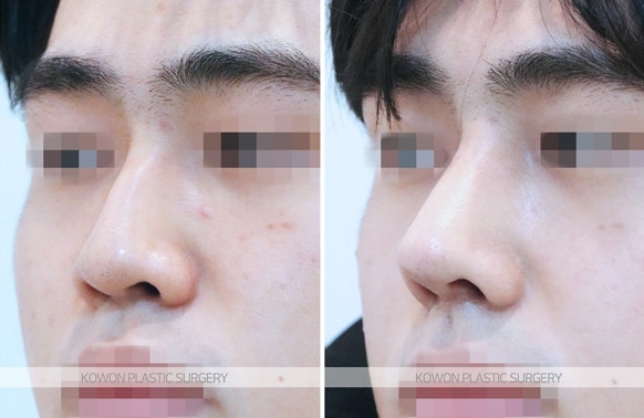 남자매부리교정 매부리절골술 전후 사진 사진 5
