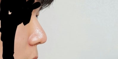 Q. 코성형코끝처짐 의심되는데