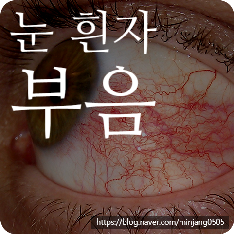 눈 흰자 부음 원인 증상