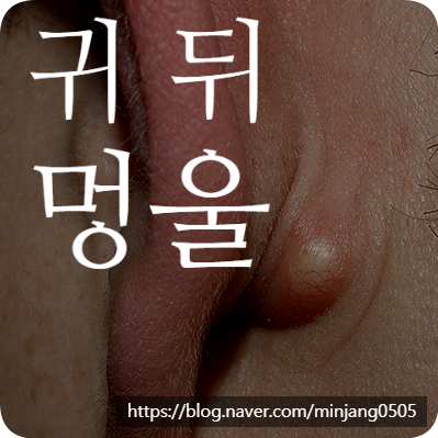 귀 뒤 멍울 어떤 질병의 증상 몽우리