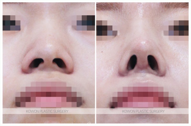 복코수술전후 과정 사례 (콧등절골) 사진 4