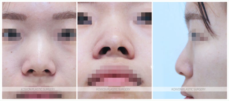 복코수술전후 과정 사례 (콧등절골)