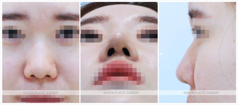 코재수술성형외과 녹는실 치료 (하이코제거)