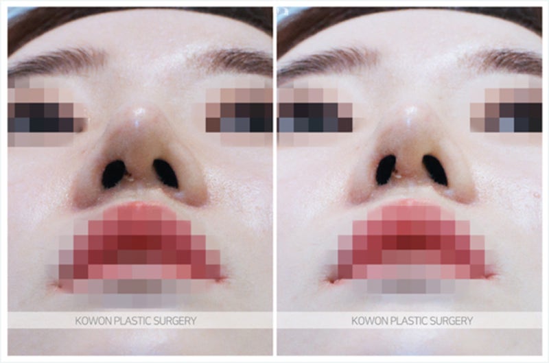 코재수술성형외과 녹는실 치료 (하이코제거) 사진 8