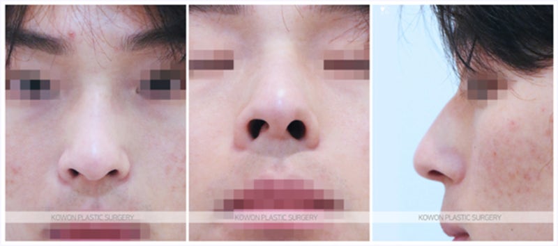 남자매부리코 성형 전후 사례 (무보형물코수술)