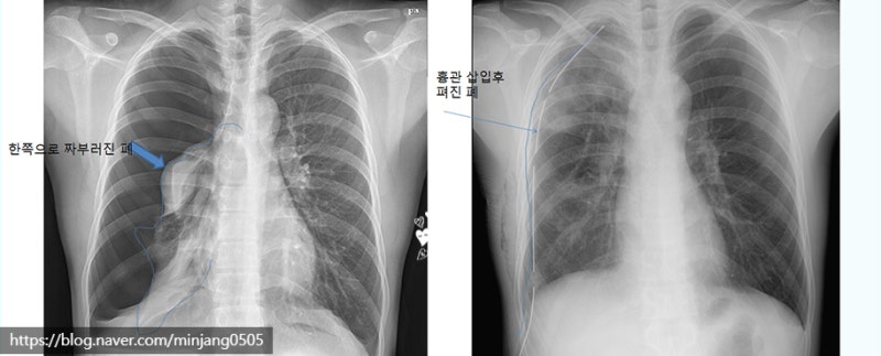 의학용어 r/o 뜻 처방 의미 풀이 사진 6