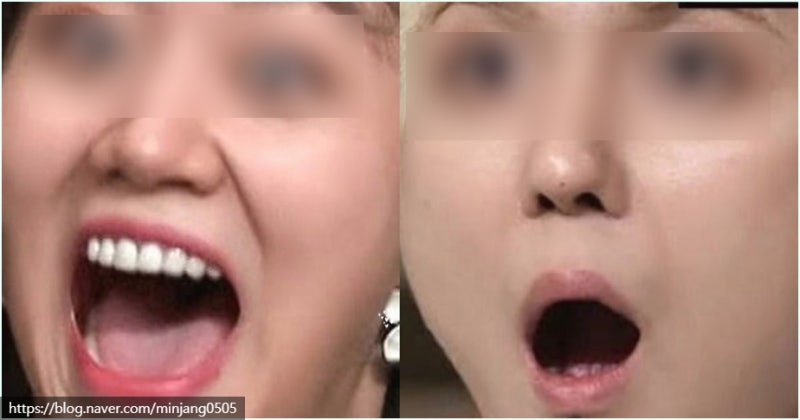 입술 옆 찢어짐 단순 건조함 원인일까 사진 3