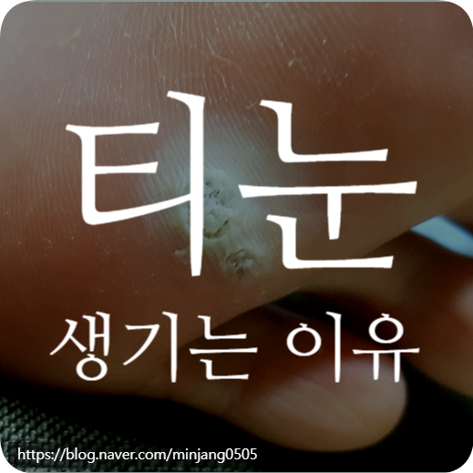 티눈 생기는 이유 제거방법 원인