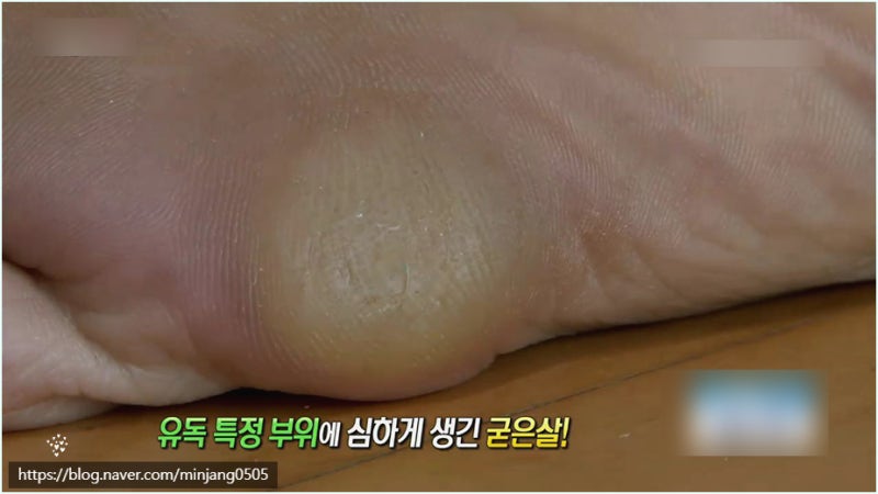 티눈 생기는 이유 제거방법 원인