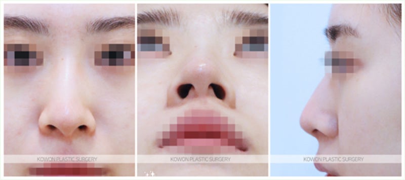 코끝연골묶기 수술 전후 비교 (코 휘어짐)