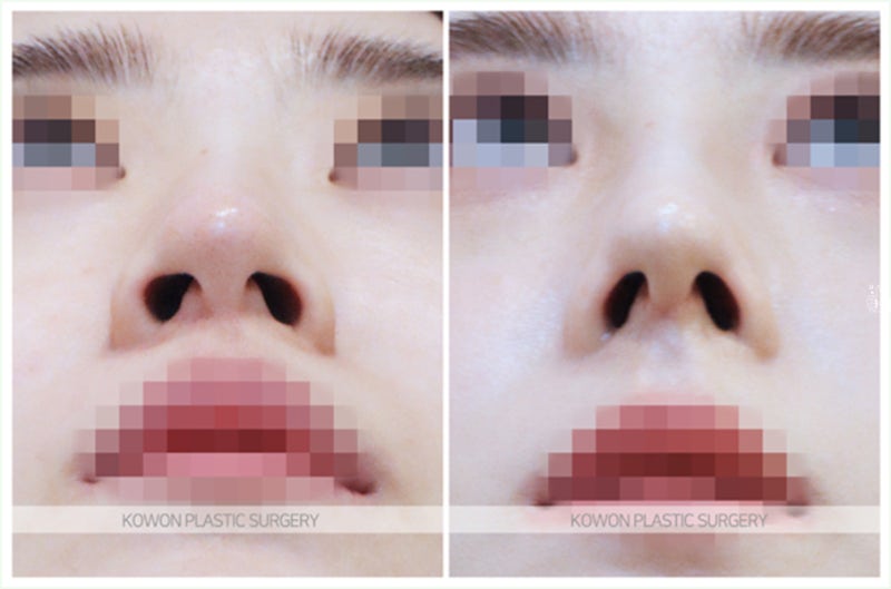 코끝연골묶기 수술 전후 비교 (코 휘어짐) 사진 7