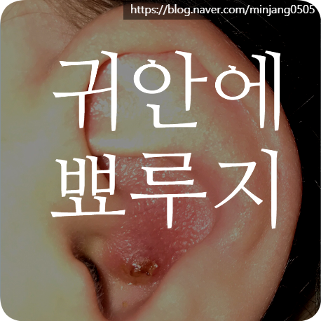 귀안에뾰루지 생기는 이유 증상
