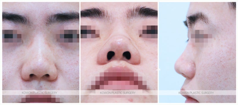 복코수술전후 성형 후기 (비중격연장)