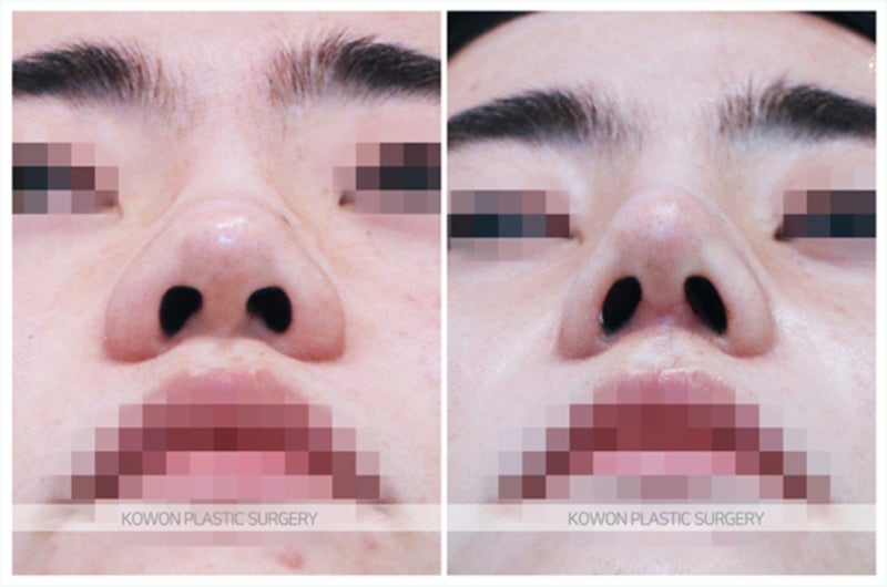 복코수술전후 성형 후기 (비중격연장) 사진 7