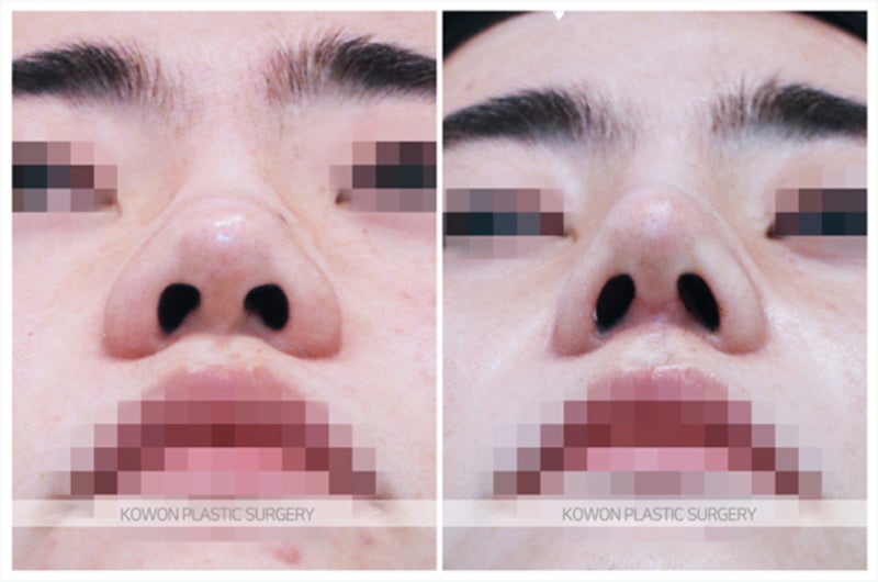 복코수술전후 성형 후기 (비중격연장)