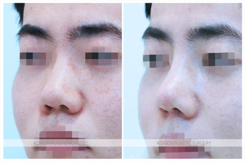 복코수술전후 성형 후기 (비중격연장) 사진 5