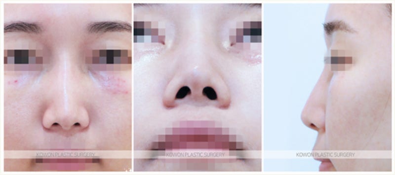 코재수술비용 만큼 부작용 따져보자 (베이코제거, 미스코제거)