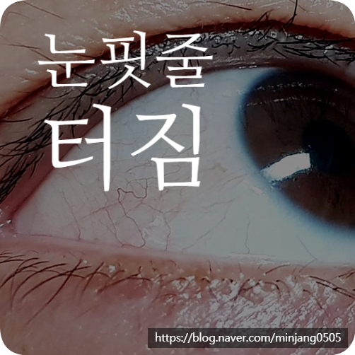 눈핏줄터짐 무슨 원인 증상 빨개짐