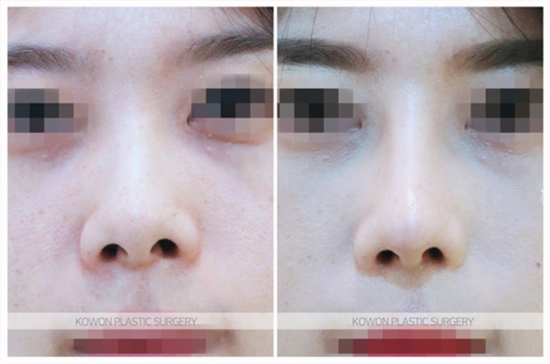 들창코 수술 전후 사례 (콧구멍비대칭) 사진 7
