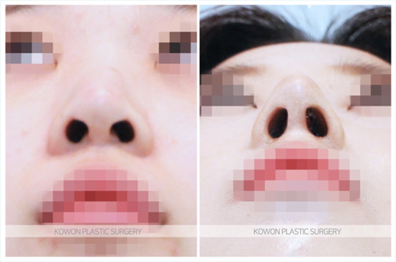 긴코성형 전후 사례 (켈로이드코수술) 사진 6