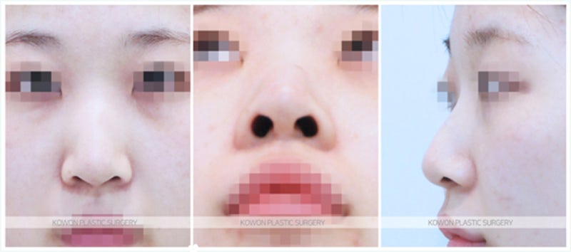긴코성형 전후 사례 (켈로이드코수술)