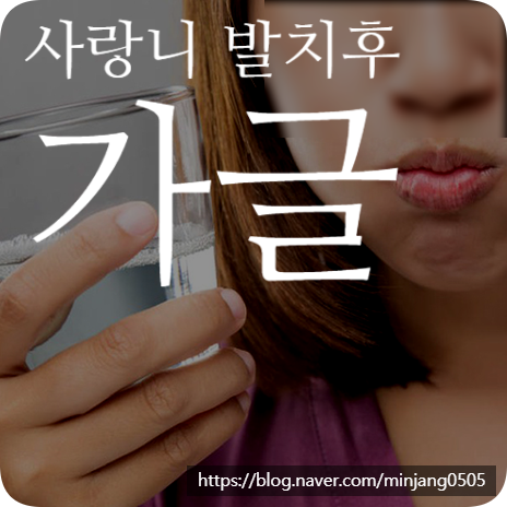 사랑니 발치후 가글 부작용 및 붓기