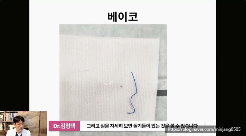 하이코 베이코 시술 실제거하는 방법 사진 9