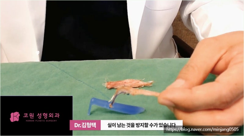 하이코 베이코 시술 실제거하는 방법 사진 11